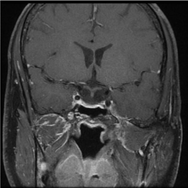 Cushing's Syndrome MRI