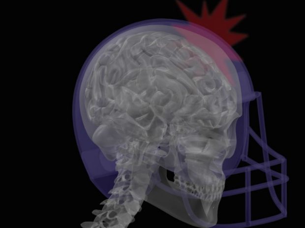 Concussion brain scan 