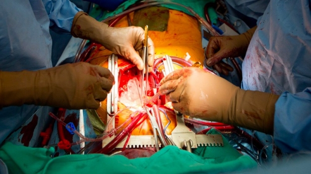 surgeons performing heart transplant