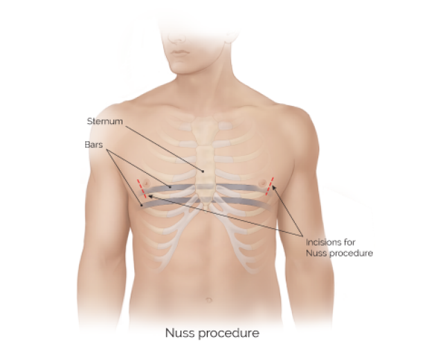 medical illustration of the Nuss procedure
