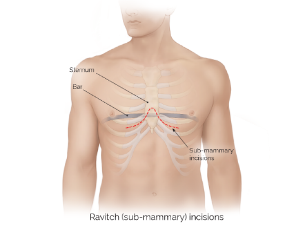 medical illustration of Ravitch sub-mammary incisions