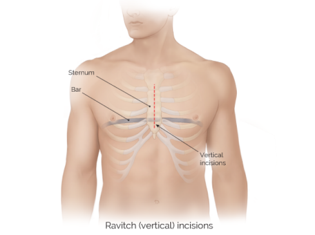 medical illustration of Ravitch vertical incisions