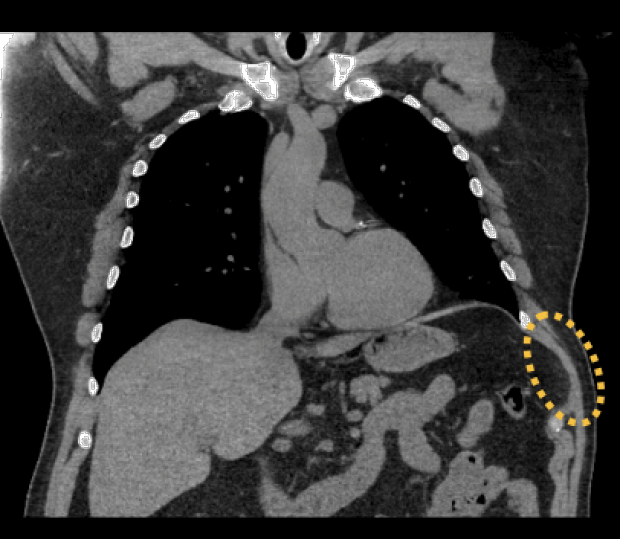 CT scan of chest wall with hernia