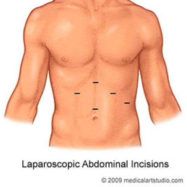 medical illustration of laparoscopic abdominal incisions