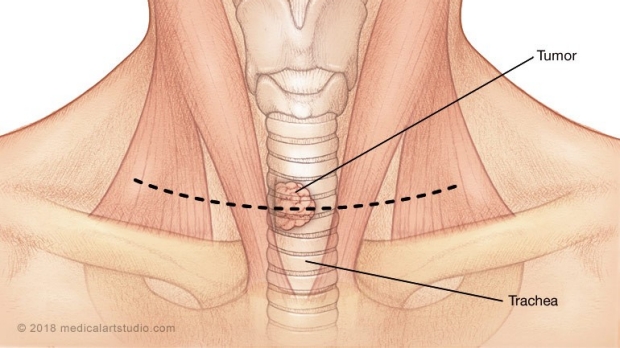 medical illustration of a tracheal tumor