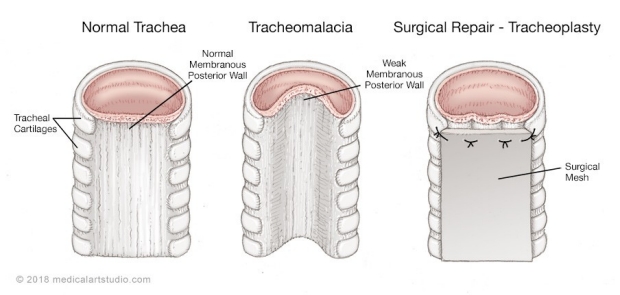 medical illustration of a tracheomalacia and tracheoplasty