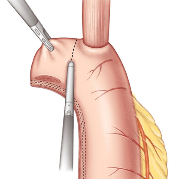 medical illustration of a completion of the Esophago-Gastric Anastomosis.