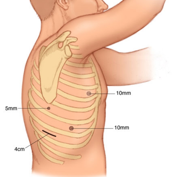 medical illustration of the right VATS incisions that are used to mobilize the esophagus.