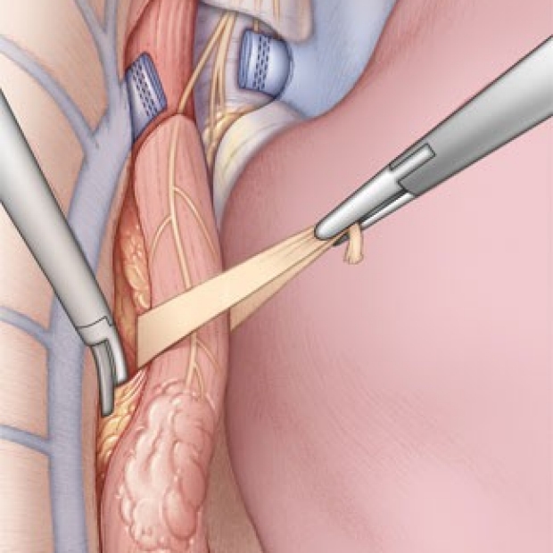 medical illustration of thoracoscopic (VATS) mobilization of the esophagus
