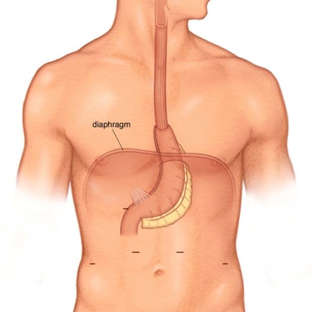medical illustration of a completed Minimally Invasive Ivor Lewis Esophagectomy.
