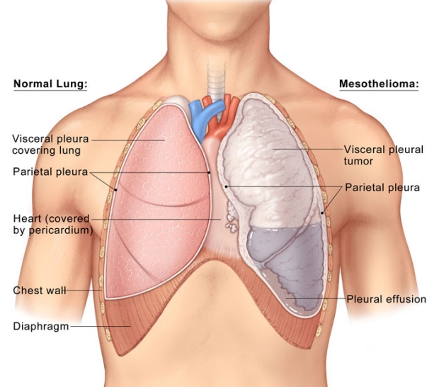 medical illustration of normal lung and mesothelioma