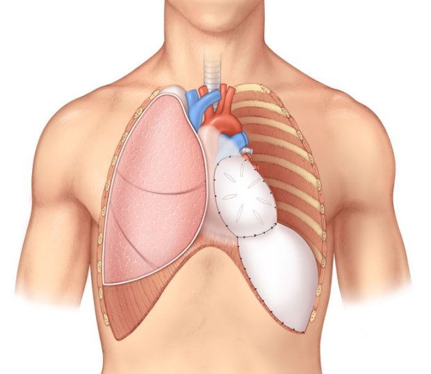 medical illustration of a extrapleural pneumonectomy