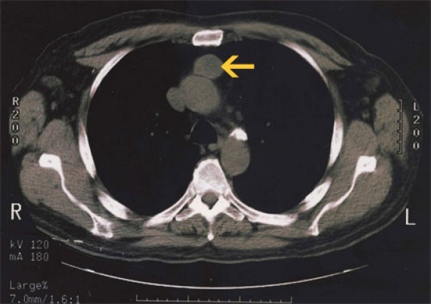 CT scan of a thymoma