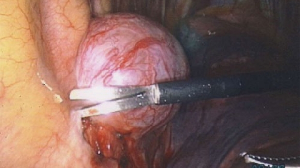 Intraoperative view of a benign, posterior mediastinal mass