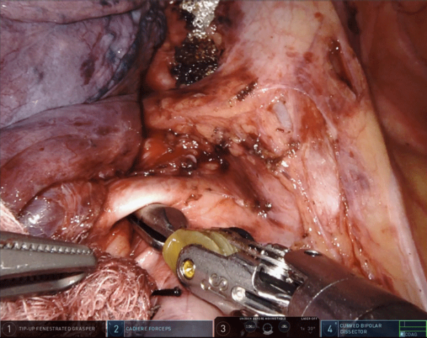 photo of a robotic surgery