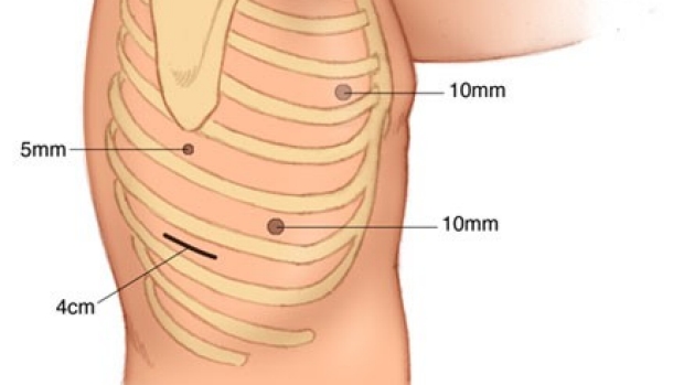 medical illustration of right VATS incisions that are used to mobilize the esophagus.