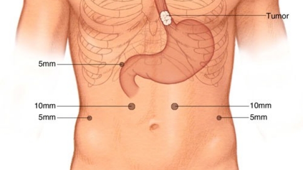 medical illustration of laparoscopic incisions for minimally invasive Ivor Lewis Esophagectomy