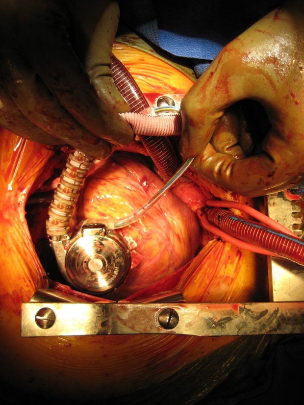 two hands in surgical gloves implanting a heart device