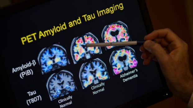 Pet Amyloid and Tau Imaging