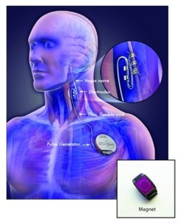Stanford epilepsy surgery Vagus Nerve Stimulation device drawing