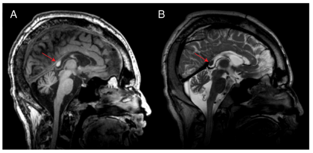 MRI image of callosotomy