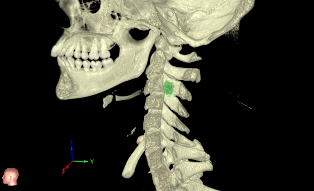 neurosurgery_VRLab_Cervical-Spine-Tumor_peds