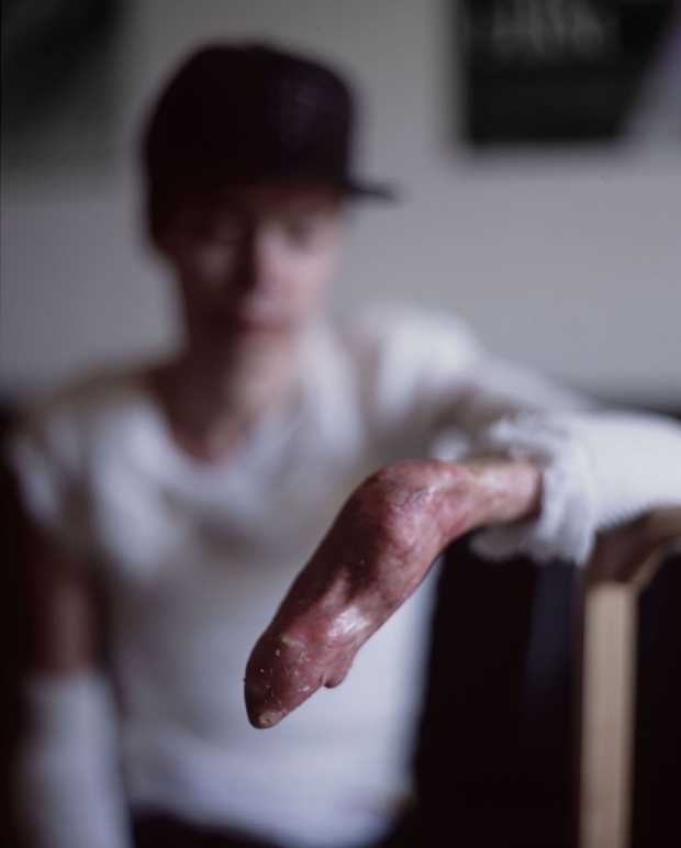 Hand of an epidermolysis bullosa patient with a small skin graft