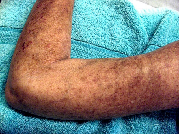 Arm of a person with scleroderma