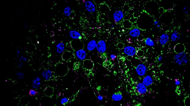 Protein clumps affect neural stem cells