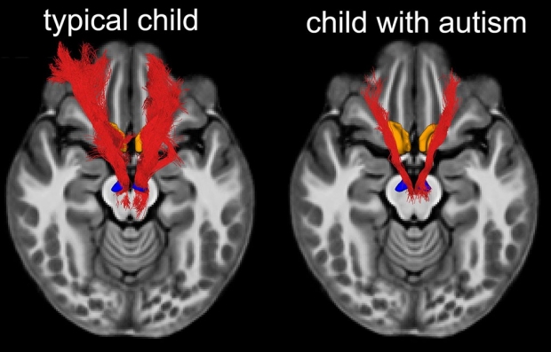 MRI brain scans of a child with autism and one without autism