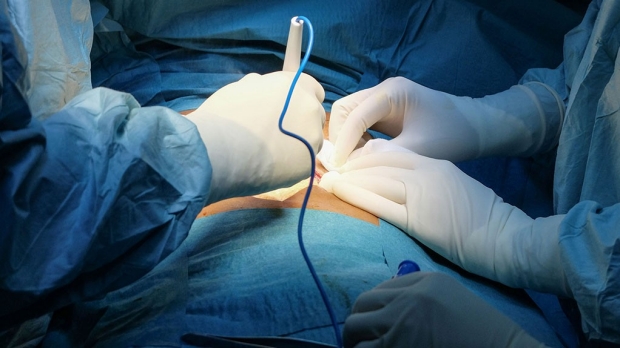 Possible therapy for surgical adhesions