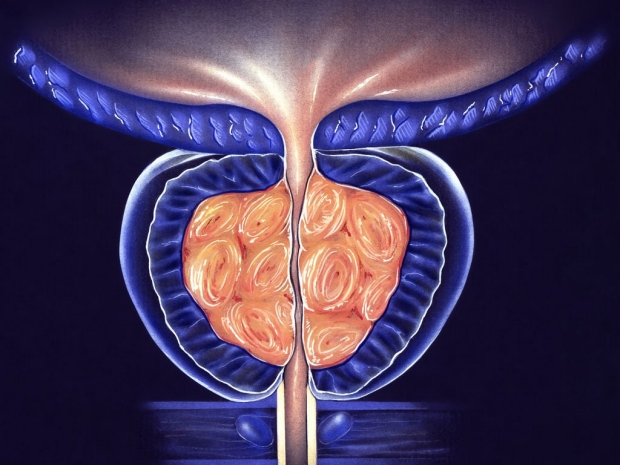 Illustration of an enlarged prostate