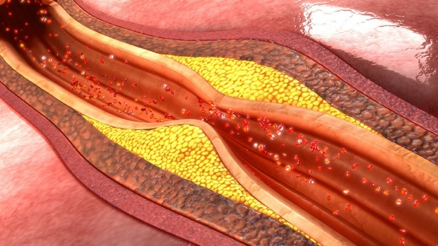 Stents, bypass surgery show no benefit in heart disease mortality rates among stable patients