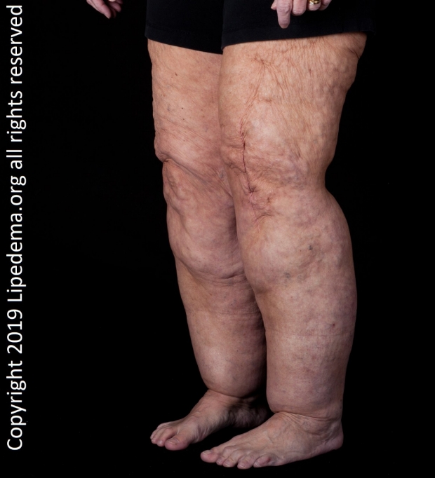 legs of woman with lipedema