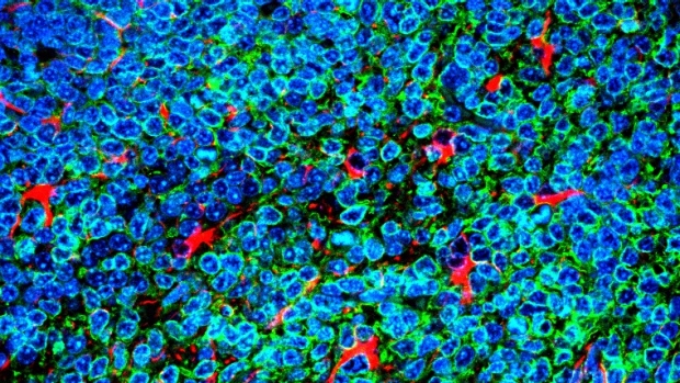 Lung cancer cells protected by brain cells