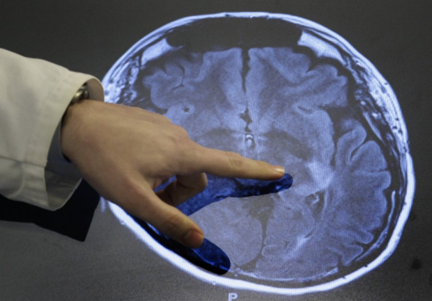 Doctor hand pointing at scan of brain with stroke